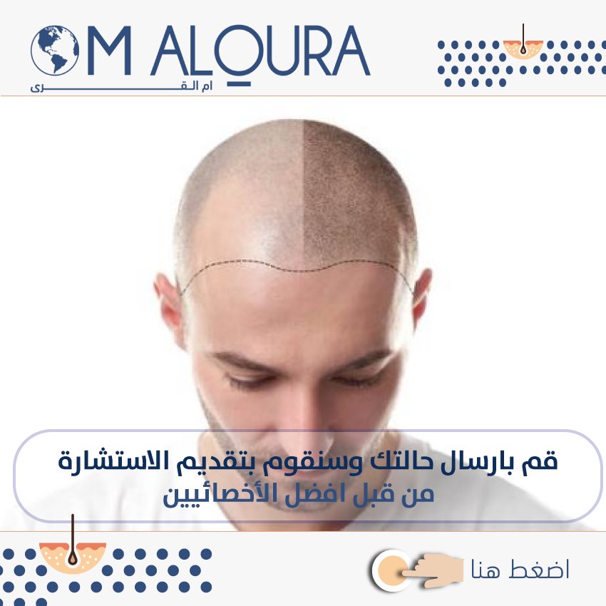 ماهو افضل مركز لزراعة الشعر في تركيا