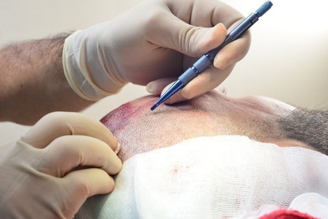 اسعار زراعة الشعر في تركيا