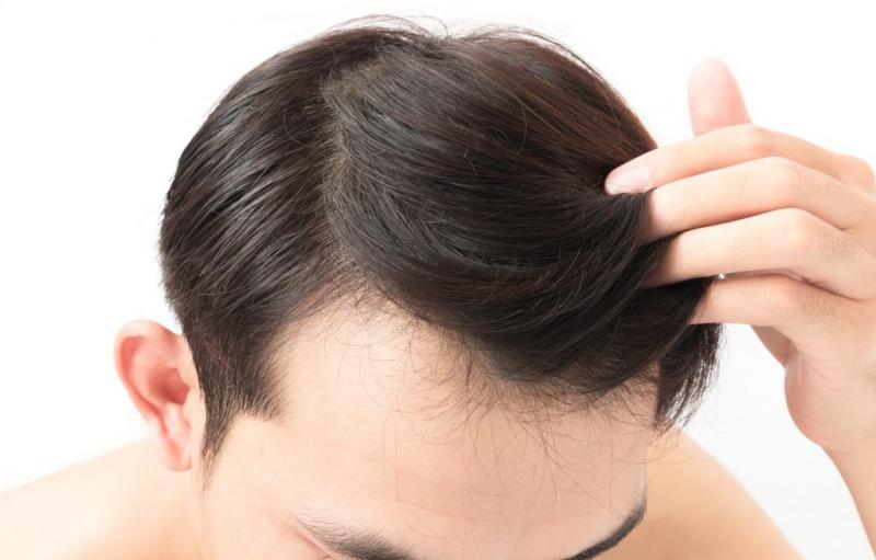 طريقة زراعة الشعر