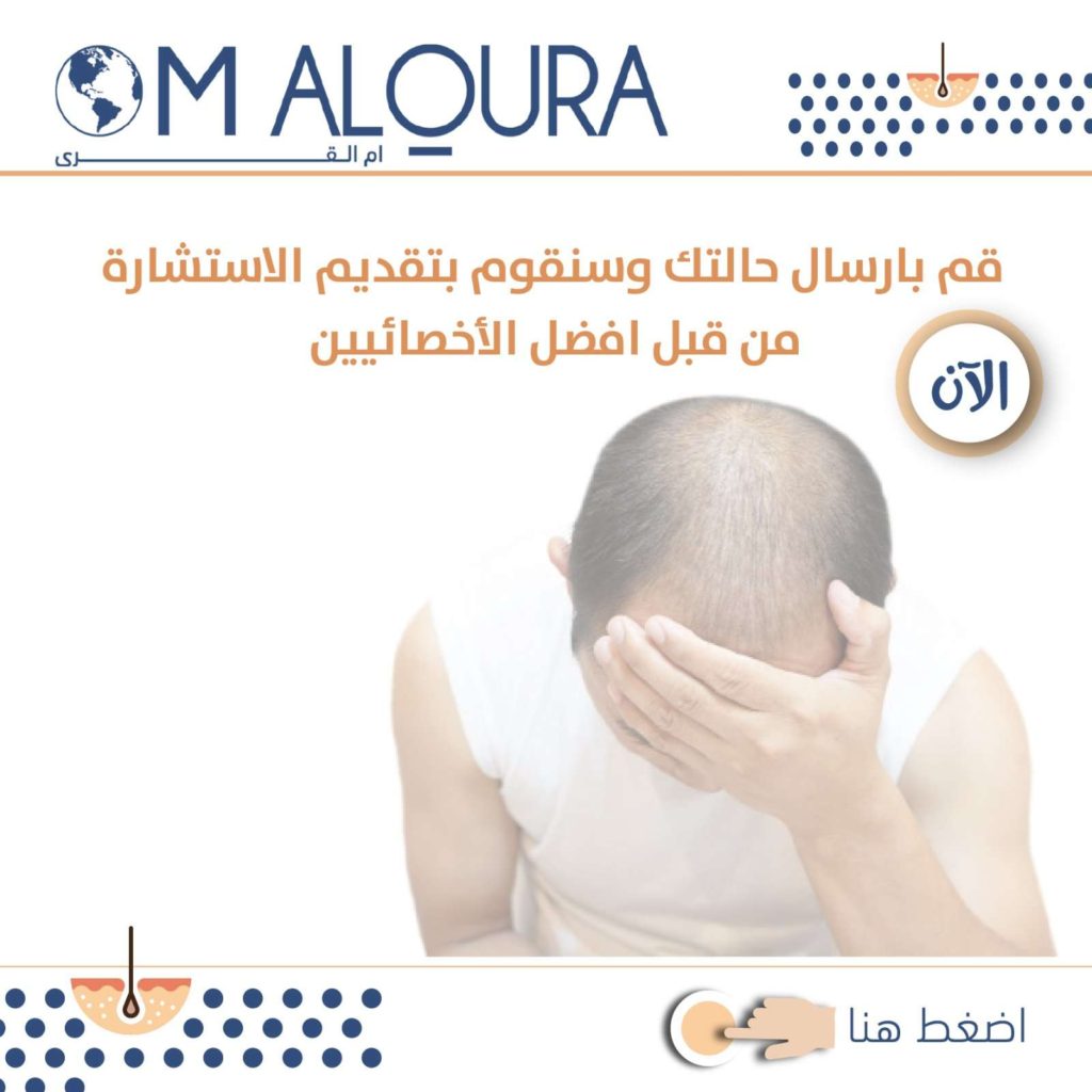 اسعار زراعة الشعر في تركيا